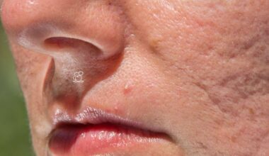 fisiopatologia das cicatrizes de acne